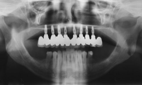 Maxillary Ridge Augmentation With Fresh-Frozen Bone Allografts