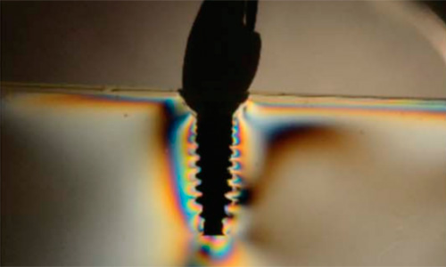 Influence of Metal and Ceramic
Abutments on the Stress Distribution
Around Narrow Implants: A Photoelastic
Stress Analysis