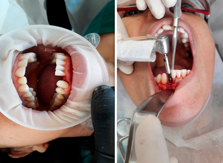 Cirurgia feita pelo Dr. Gustavo Gessi, com implante Cone Fix.