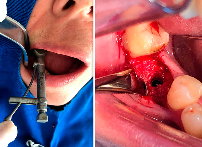 Cirurgia feita pelo Dr. Gustavo Vinholi com implante Avantt.