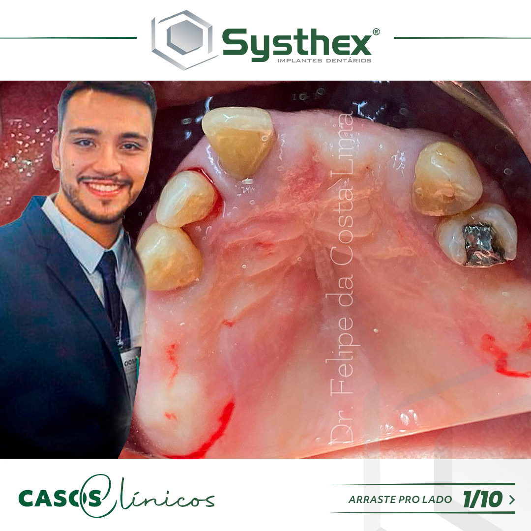 caso-clinico-systhex-implantes-dentario-dr-felipe-lima-carga-imediata-followup-9meses