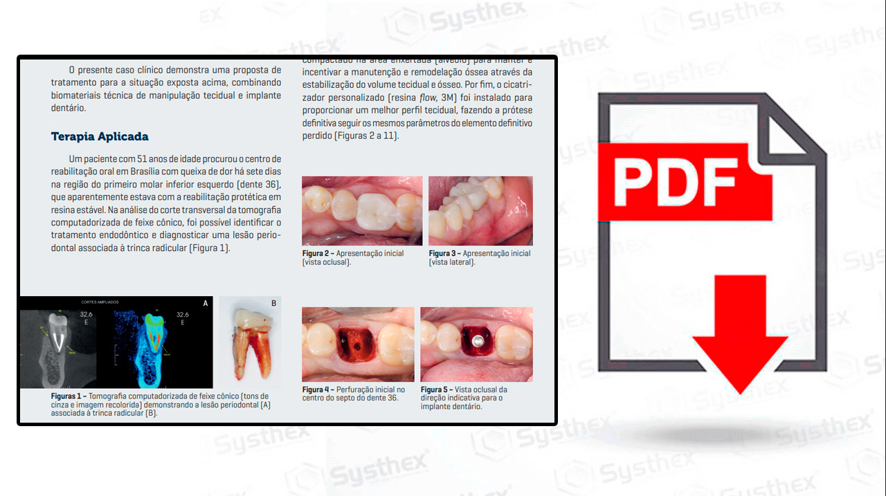 thumb-saulo-Personalizacao-cicatrizador-pos-exodontia-elemento-dentario-trinca-radicular